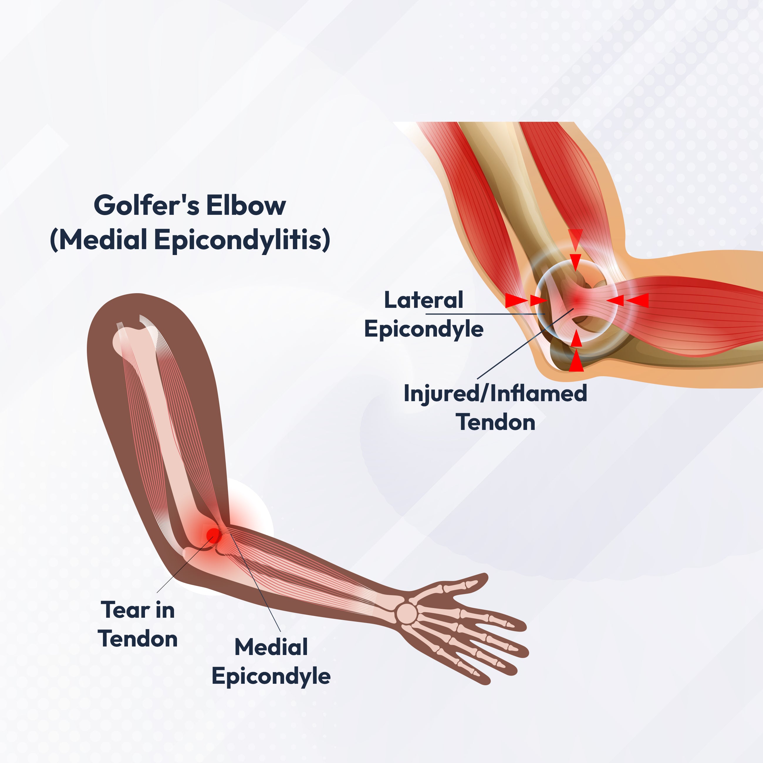 I5Joints Far Infrared Magnetic Elbow Support Belt – Pain Relief Elbow Brace & Sleeve for Tennis, Badminton, Cricket & Sports (Men & Women) I5Joints Far Infrared Magnetic Elbow Support Belt – Pain Relief Elbow Brace & Sleeve for Tennis, Badminton, Cricket & Sports (Men & Women)